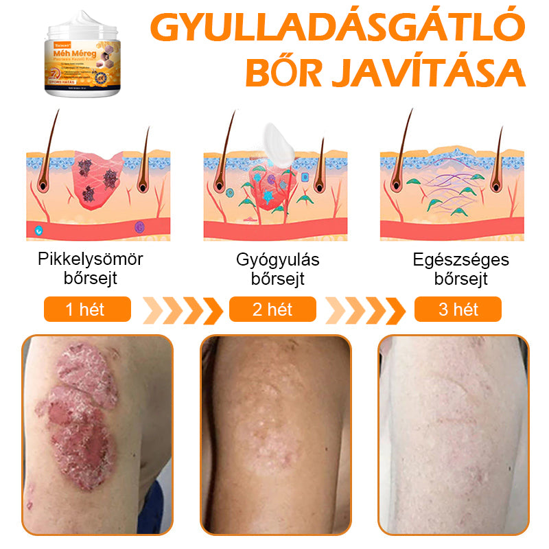 🏆【Hivatalos Márkabolt】BŐRERŐ™ Méh Méreg Psoriasis Kezelő Krém（⭐Pikkelysömör⭐Szemölcs⭐Körömgomba⭐））