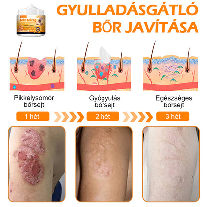 🏆【Hivatalos Márkabolt】BŐRERŐ™ Méh Méreg Psoriasis Kezelő Krém（⭐Pikkelysömör⭐Szemölcs⭐Körömgomba⭐））
