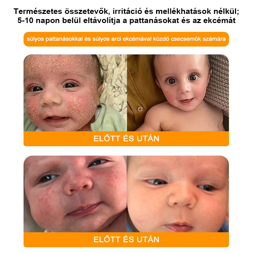 🌼GŐYUIŐ™ Szemölcs eltávolító és halványító krém🍯 4-6 héten belül teljesen eltávolítja a bőrcímkéket, szemölcsöket, pattanásokat és bőrpírt, klinikailag igazolt👩🏼‍⚕️ (Bőrgyógyászok erősen ajánlják)