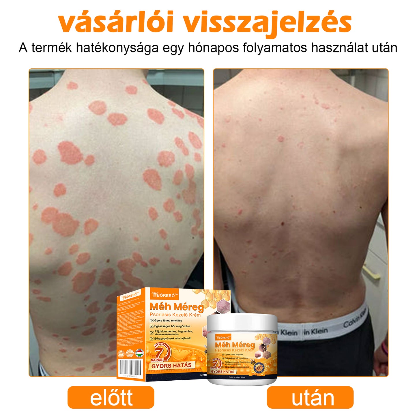 🏆【Hivatalos Márkabolt】BŐRERŐ™ Méh Méreg Psoriasis Kezelő Krém（⭐Pikkelysömör⭐Szemölcs⭐Körömgomba⭐））