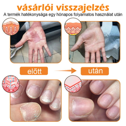 🏆【Hivatalos Márkabolt】BŐRERŐ™ Méh Méreg Psoriasis Kezelő Krém（⭐Pikkelysömör⭐Szemölcs⭐Körömgomba⭐））