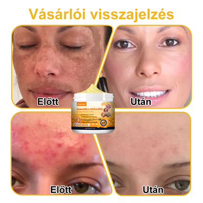 🌼GŐYUIŐ™ Szemölcs eltávolító és halványító krém🍯 4-6 héten belül teljesen eltávolítja a bőrcímkéket, szemölcsöket, pattanásokat és bőrpírt, klinikailag igazolt👩🏼‍⚕️ (Bőrgyógyászok erősen ajánlják)