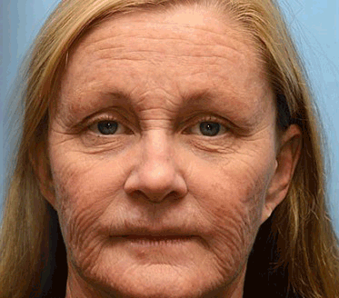 🏵️【Hivatalos Márkabolt】FRISSARC™ Botox Méhméreg Ránctalanító Krém